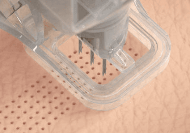 Ellacor Microcoring and Why Tighter Skin Might Not Mean What You Think