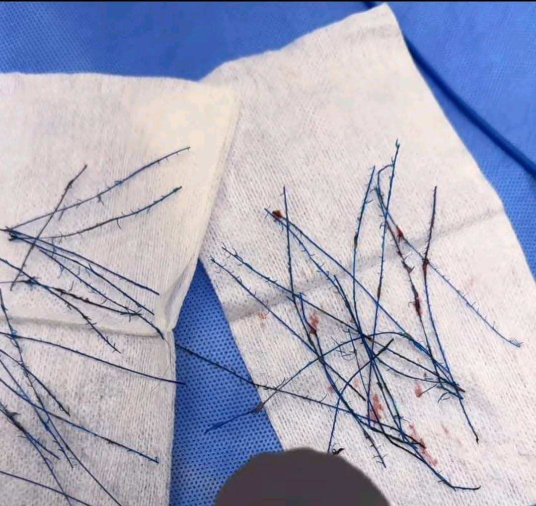 Thread Lifts. What Nobody Tells You Before You Say Yes.